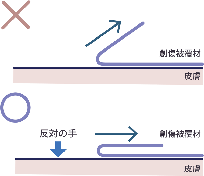 創傷被覆材を皮膚に対して180度折り返すようにはがす方法の図