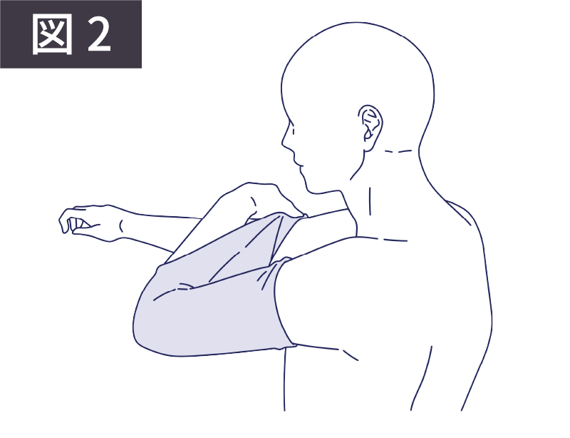 図2:腕を通して包帯を二の腕までたぐり寄せる例